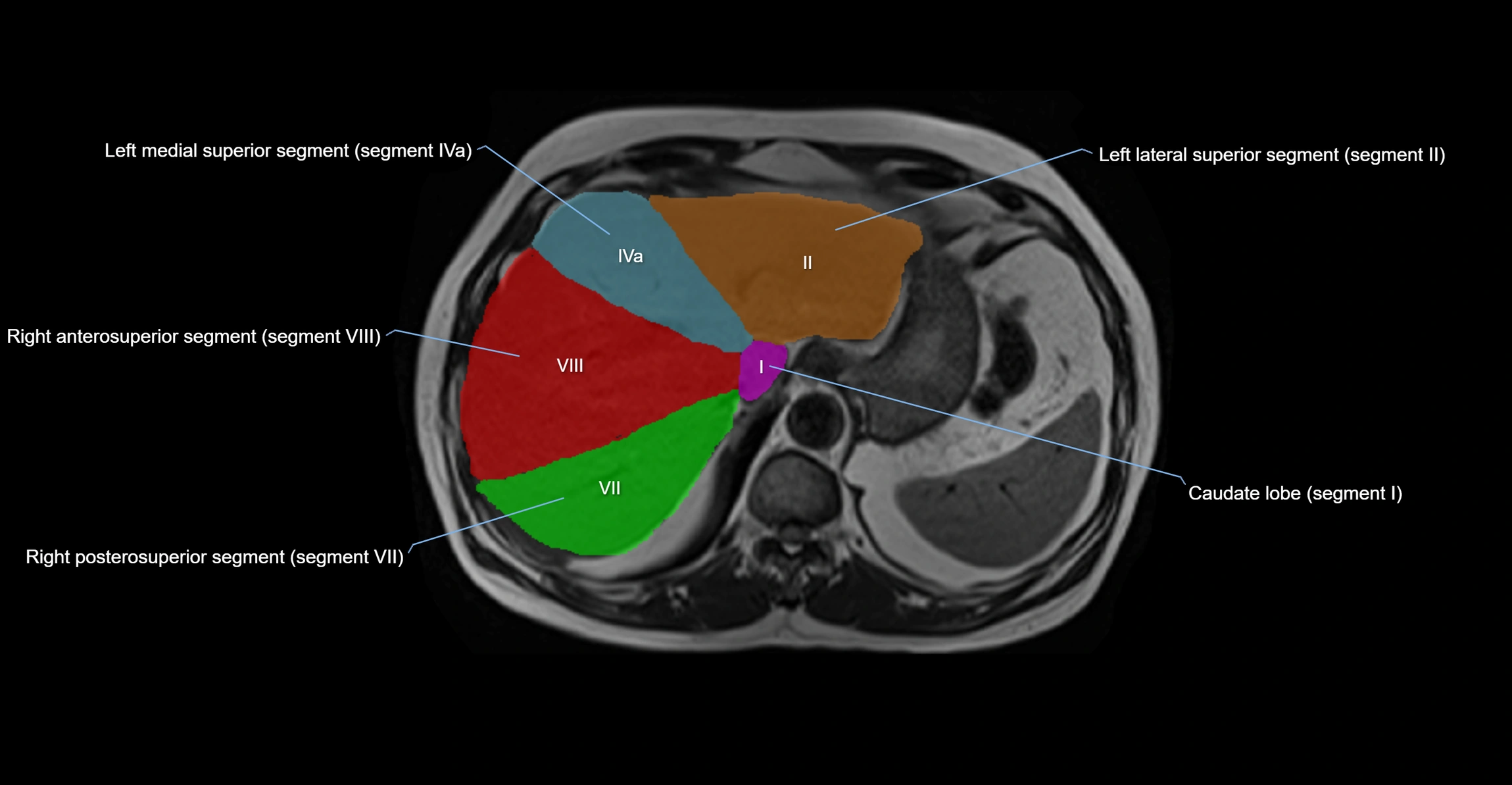 MRI  liver segments anatomy axial cross sectional 3T radiology  image-img-00001-00009.webp
